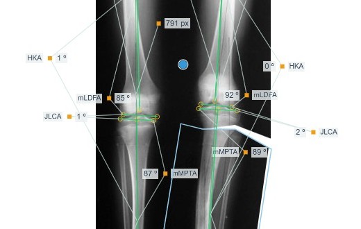 Preoperative Planning knee-measurement view: crossing mechanical-axis lines with mLDFA, mMPTA, JLCA and HKA angle annotations on both legs.