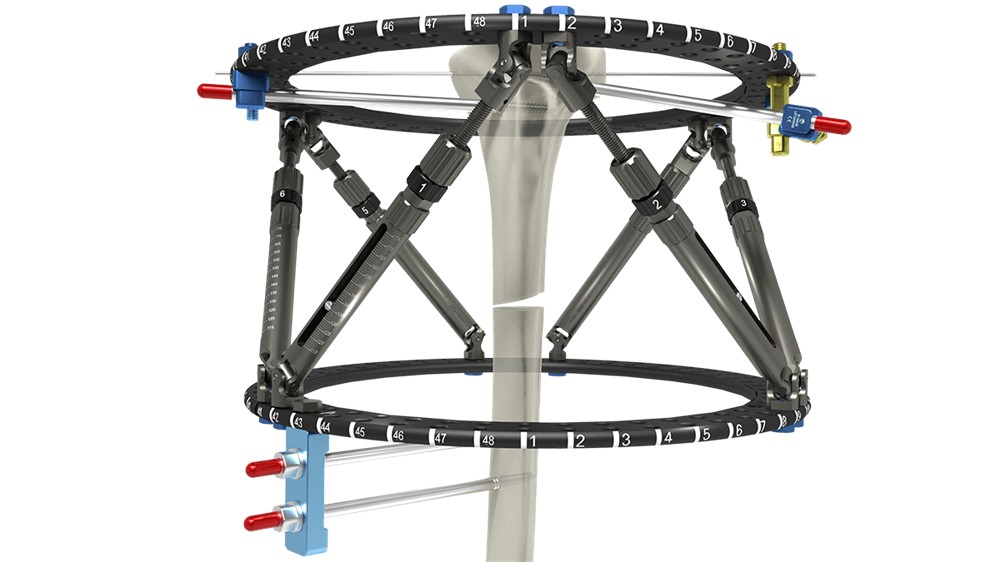 Smart Fixator hexapod frame around a bone, showing two carbon-fibre rings joined by six adjustable struts.